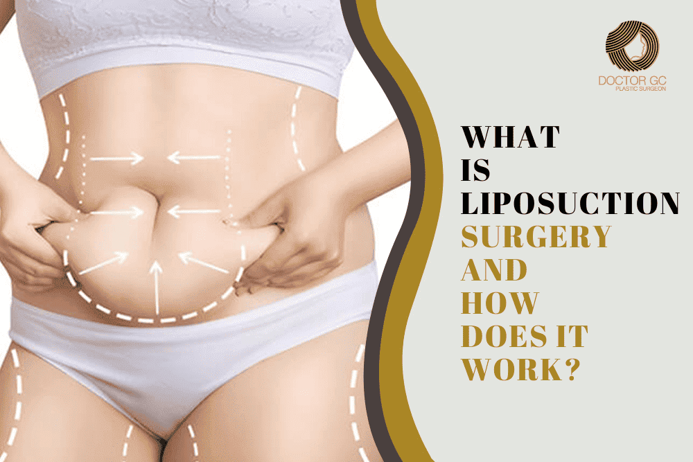 What Is Liposuction Surgery and How Does It Work?