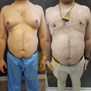 Before and After Result ​