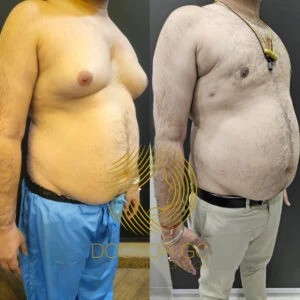 Before and After Result ​