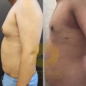 Before and After Result ​