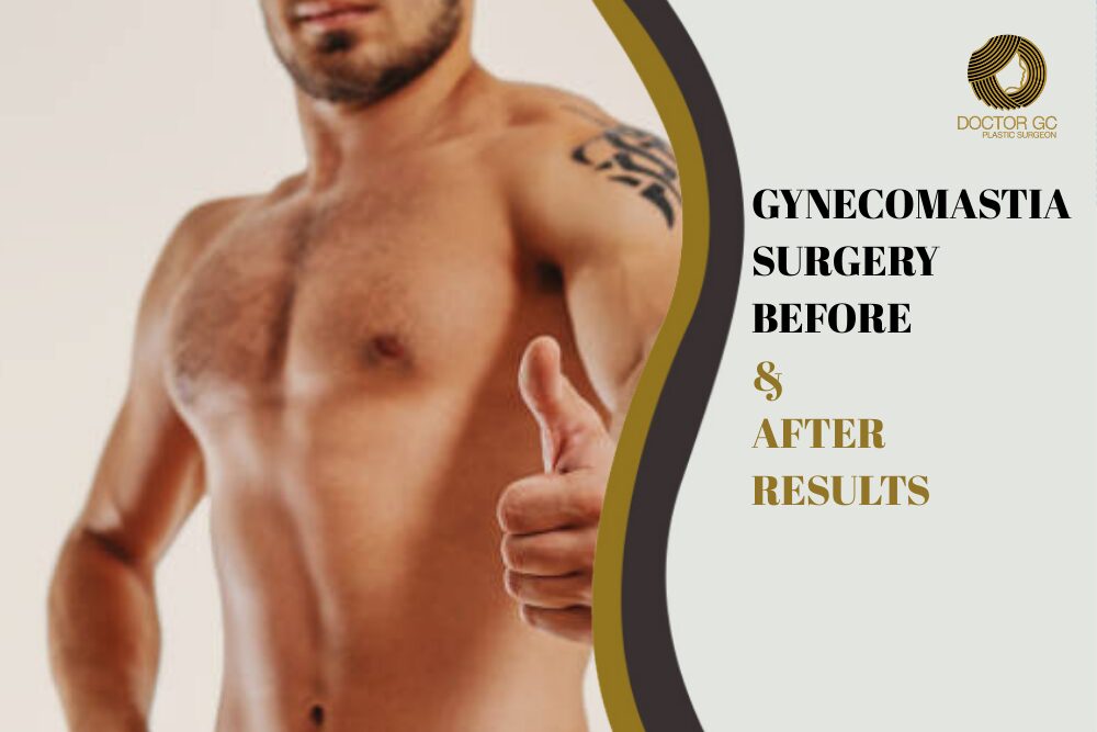 Gynecomastia Surgery Before & After Results
