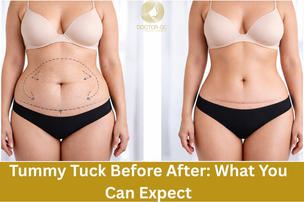 tummy tuck before after