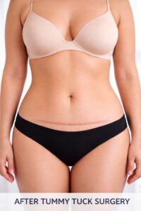 tummy tuck before after