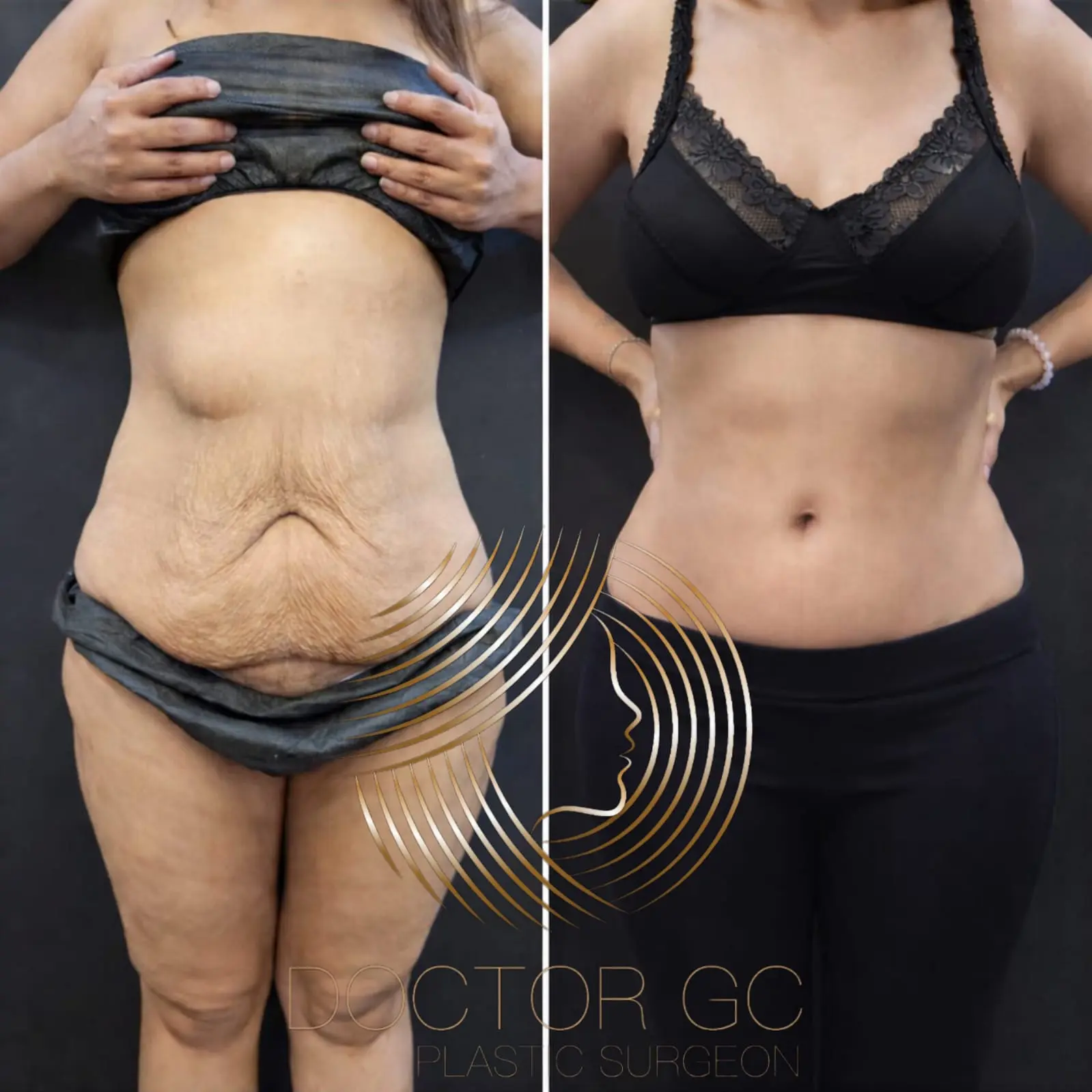 Liposuction results