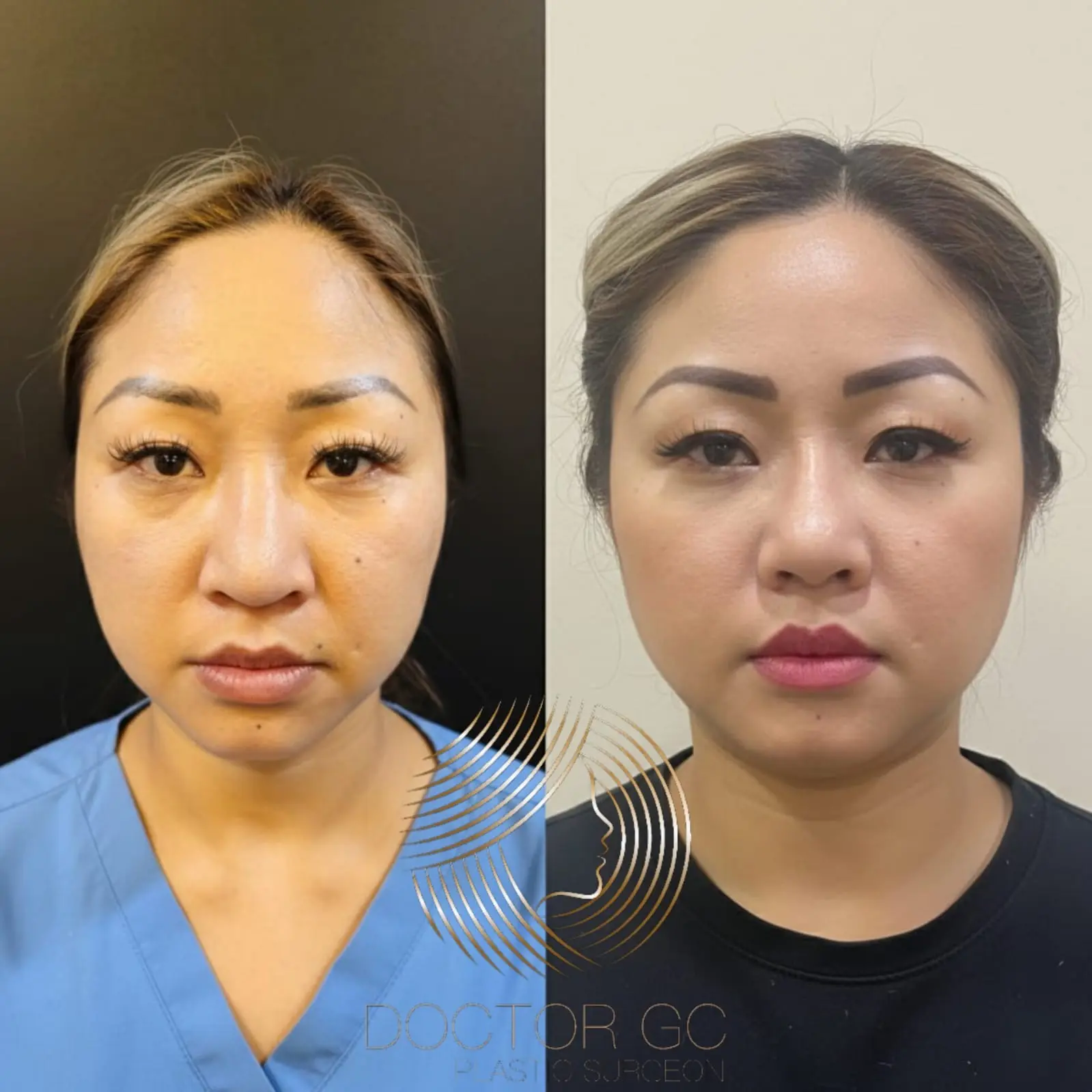 Rhinoplasty results