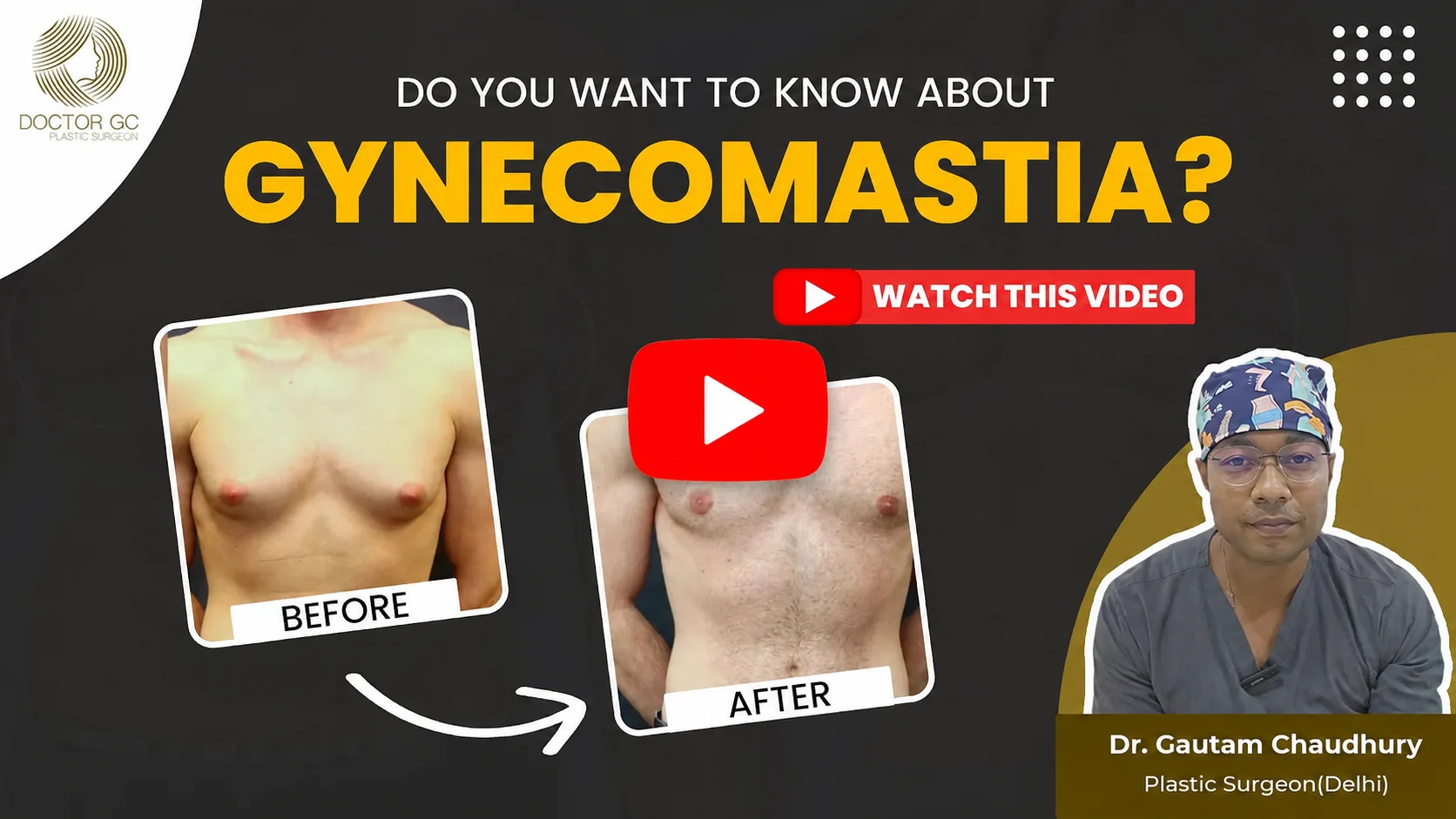 gynecomastia video
